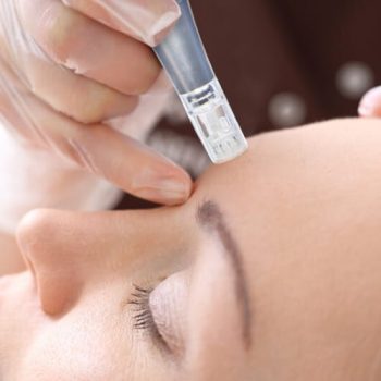 microneedling