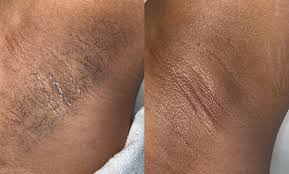 pits armpit waxing