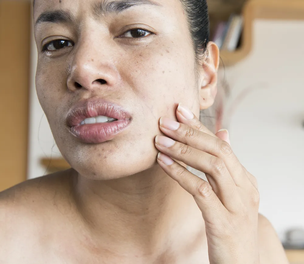 Is your excessively oily skin actually dry?