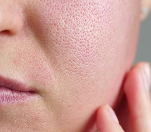 how to reduce enlarged pores