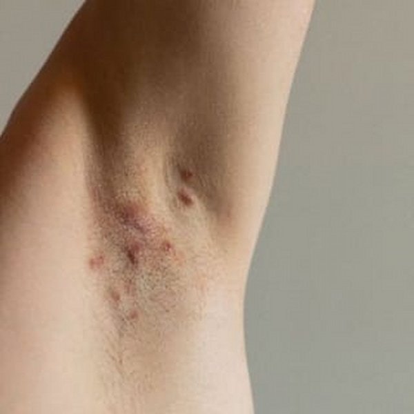 Hidradenitis Suppurativa (HS)