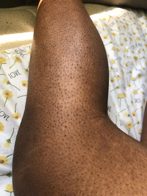 strawberry legs blog