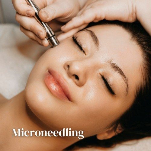 Microneedling Treatment Raleigh NC